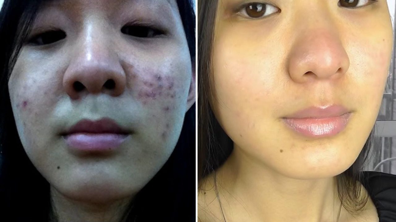 My 10 Personal Tips To Cure Acne Naturally Fitneass