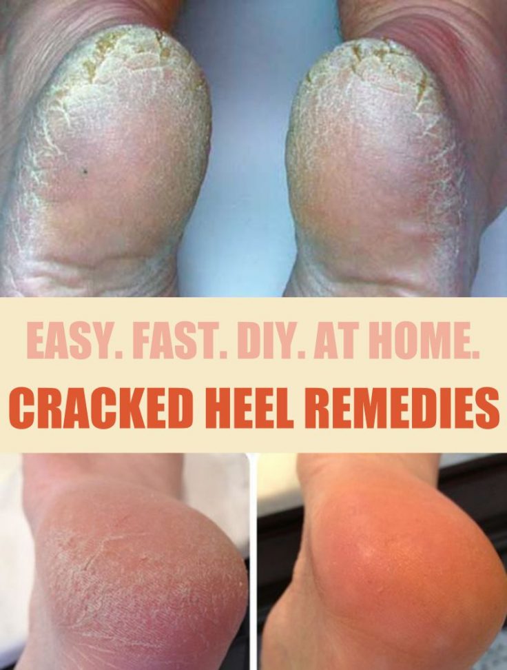 Cracked Heel Remedies For Super Soft 