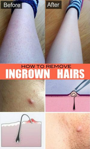 How To Remove Ingrown Hairs From Under The Skin - Fitneass