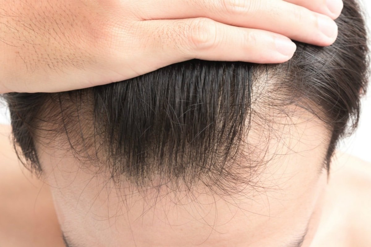 7 Simple Ways To Help Prevent Hair Loss In Men Fitneass