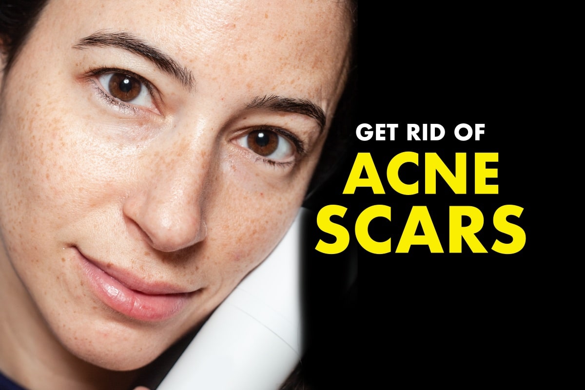 10 Natural Remedies For Acne Scars Fitneass